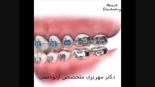 آسیب به براکت و سیم ارتودنسی