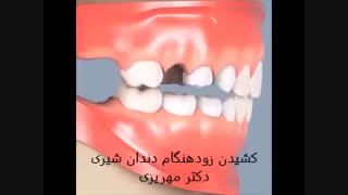 فضانگهدار بجای دندان شیری
