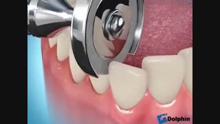 استریپ  ارتودنسی- دکتر سهراب آصفی