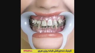 فیلم ارتودنسی ثابت دندان
