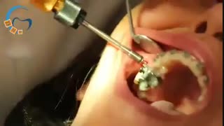 مینی اسکرو در ارتودنسی | دکتر مسعود داوودیان