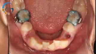 کشیدن دندان در ارتودنسی | دکتر مسعود داوودیان