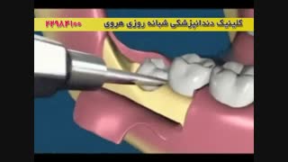 فیلم جراحی دندان عقل / دندان عقل نهفته