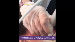 میکرونیدلینگ موثرترین روش جوانسازی