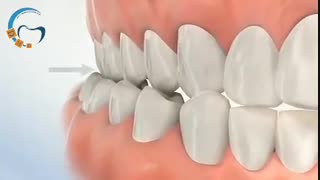 ارتودنسی جلو بودن فک پایین بدون کشیدن دندان | دکتر داوودیان