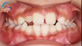 ارتودنسی پیشگیری در دوران دندانی مختلط  | دکتر داوودیان