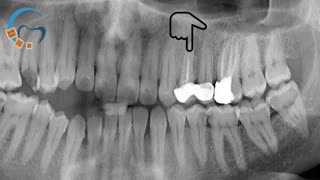 ارتودنسی همراه جراحی فک و کشیدن دندان | دکتر مسعود داوودیان