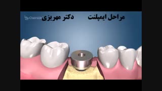 مراحل ایمپلنت دندان