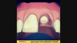 فیلم کاشت ایمپلنت دندان جلویی