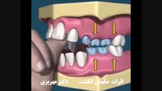 اثرات مخرب مکیدن انگشت بر دندان ها