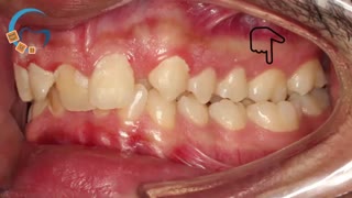 ارتودنسی دیپ بایت | دکتر مسعود داوودیان