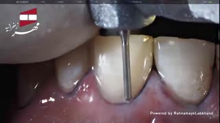 لمینیت سرامیکی دندان | کلینیک دندانپزشکی مهر زعفرانیه