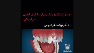 اصلاح شکل و رنگ دندان‌ها به کمک لامینیت سرامیکی