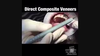 اصلاح طرح لبخند با ونیر کامپوزیت