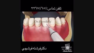 جرمگیری با دستگاه اولتراسونیک