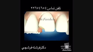 اصلاح شکستگی دندان با کامپوزیت