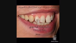 بستن فواصل بین دندانی و اصلاح شکل دندان با کامپوزیت