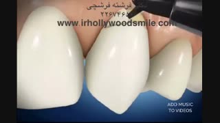 اصلاح ابرژن(ساییدگی) دندانی با کامپوزیت