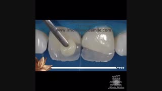 اصلاح شکستگی دندان با کامپوزیت