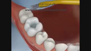 ترمیم پوسیدگی دندان با کامپوزیت