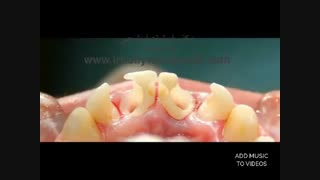 ترمیم پوسیدگی های دندانی با کامپوزیت