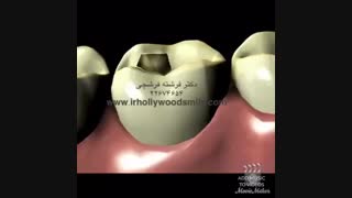 ترمیم  پوسیدگی دندان