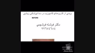 برخی از کاربردهای کامپوزیت در دندانپزشکی زیبایی