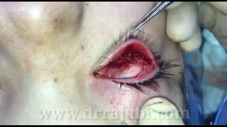 نقص مادرزادی و عدم تشکیل چشم راست بیمار ۲۲ ساله