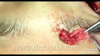 جراحی تومور اربیت ( orbital tumor )و جا به جایی کره چشم