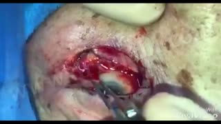 جراحی تومور پلک پایین