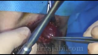 خارج کردن تومور اربیت چشم بسیار بزرگ