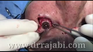 جراحی تومور وسیع پلک پایین