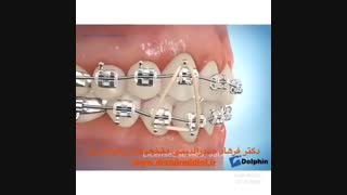 ارتودنسی قبل و بعد