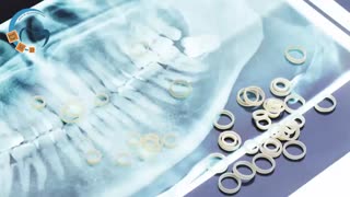 استفاده از پاوراسکوپ بجای کش ارتودنسی | دکتر داوودیان