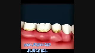 آیا جرم های دندان می توانند مشکل ایجاد کنند؟