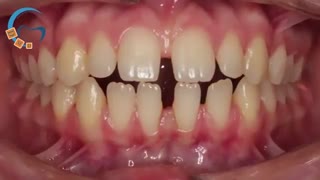 ارتودنسی دندانهای فاصله دار | دکتر مسعود داوودیان