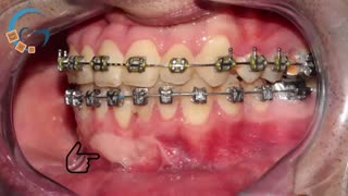 ارتودنسی کراس بایت با سیستم دیمون| دکتر مسعود داوودیان