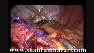 گاسترکتومی یا برداشتن معده توسط دکتر شهرام نظری