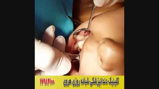 فیلم عصب کشی دندان