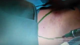 درمان قطعی عرق ریزش زیر بغل با ساکشن - دکتر مقیمی  www.ebiderm.blogfa.com