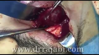 تومور اربیت بسیار بزرگ در چشم راست