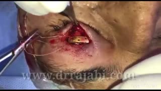 کارگذاری پلاک طلا در پلک بعلت فلج عصب صورت