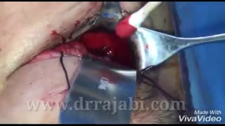 تومور بزرگ داخل کاسه چشم باگسترش به شکاف اربیتال تحتانی