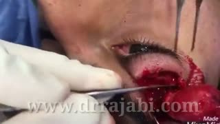 توموربزرگ مادرزادی در بالای کاسه چشم و روی ابرو