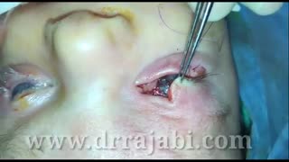 عدم تشکیل پلک فوقانی و چسبندگی پوست به قرنیه