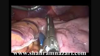 اسلیو معده فایل صوتی تصویری