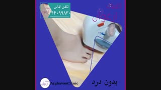 رفع موهای زاید پا
