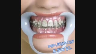 تاثیر ارتودنسی دندان بر زیبایی خنده