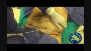 لیپوماتیک - دکتر ابدالی 22807060 جرمگیری