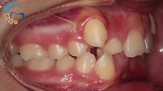 ارتودنسی به کمک دستگاه هدگیر  | دکتر مسعود داوودیان